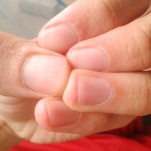 Rounded and swollen fingertips (clubbing)